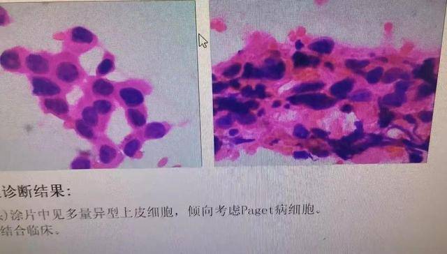 以为是湿疹，结果竟是癌！宁波女子悔惨：反复涂了一年药膏都没好！很多患者首诊都去了皮肤科